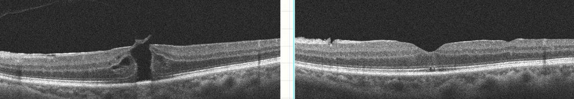 OCT avant et après chirurgie d'un trou maculaire — comparaison pré et post-opératoire